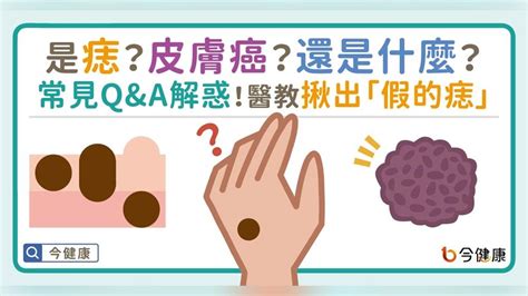 痣 形成原因|是痣？皮膚癌？還是什麼？常見Q&A解惑！醫教揪出「。